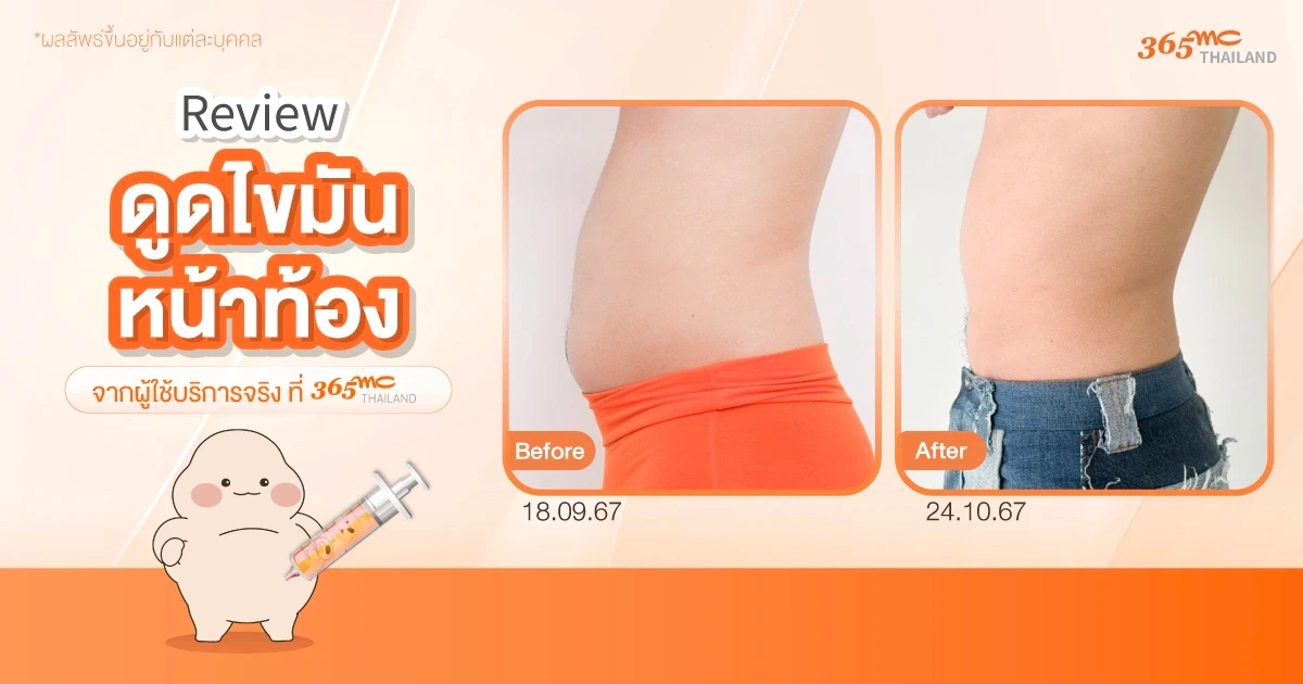 รีวิวดูดไขมันหน้าท้อง