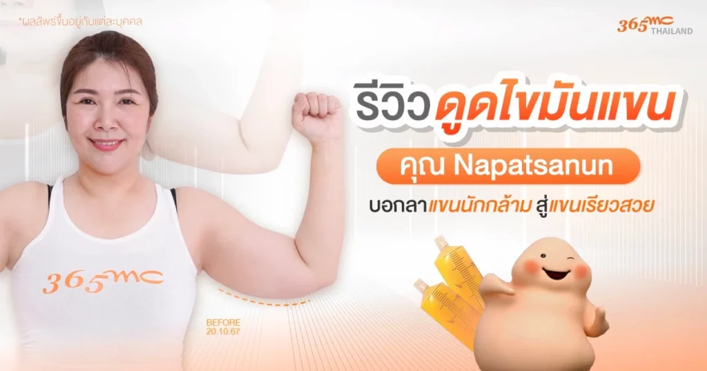 รีวิวดูดไขมันแขน