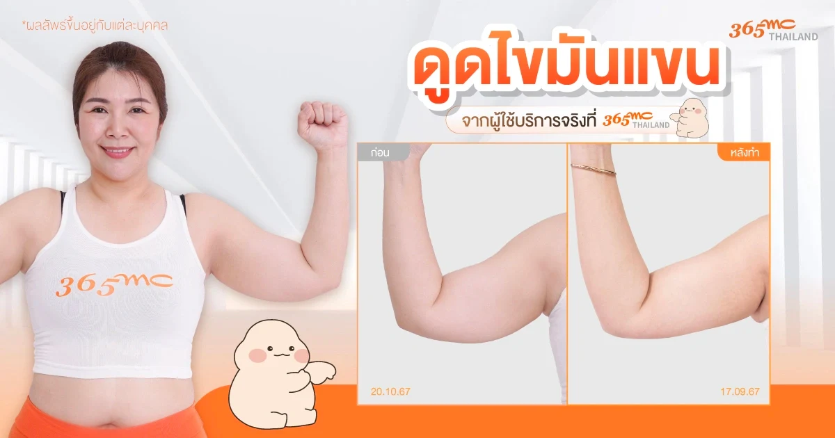 รีวิวดูดไขมันแขน