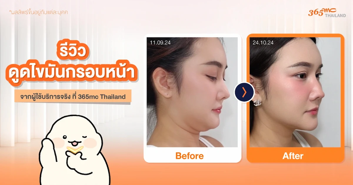 รีวิวดูดไขมันหลังครบ 1 เดือน
