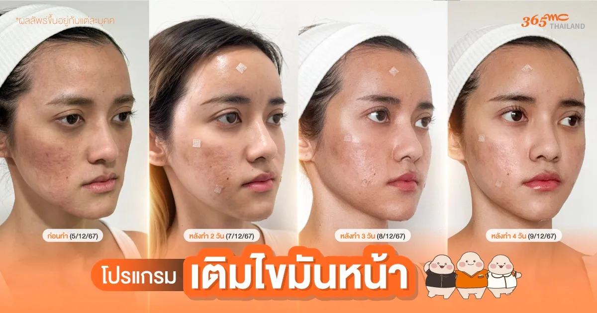 รีวิวเติมไขมันหน้า คุณป้อน