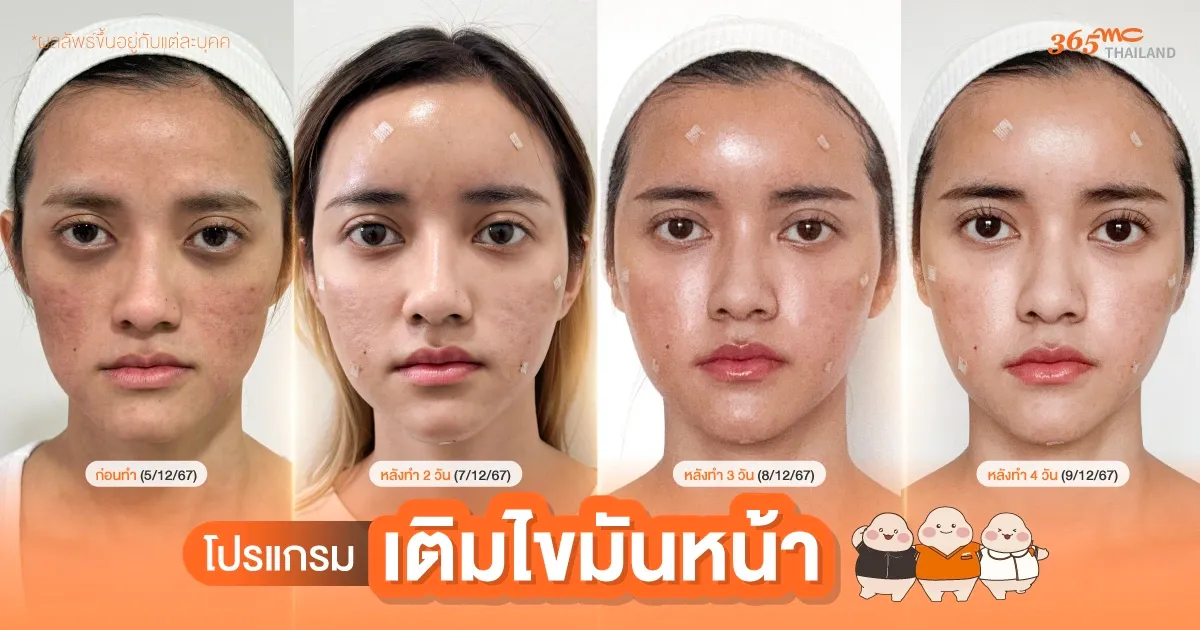 รีวิวเติมไขมันหน้า คุณป้อน