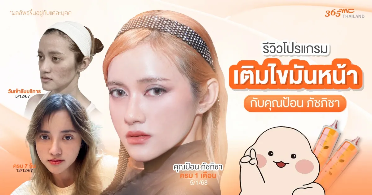 รีวิวเติมไขมันหน้า