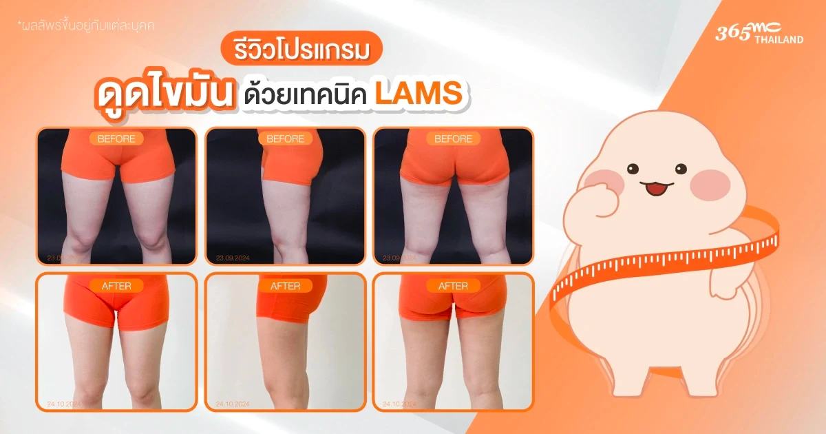 รีวิวดูดไขมันขา