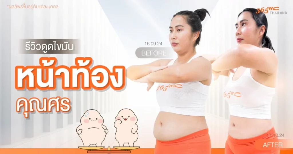 รีวิวดูดไขมันหน้าท้อง คุณศร