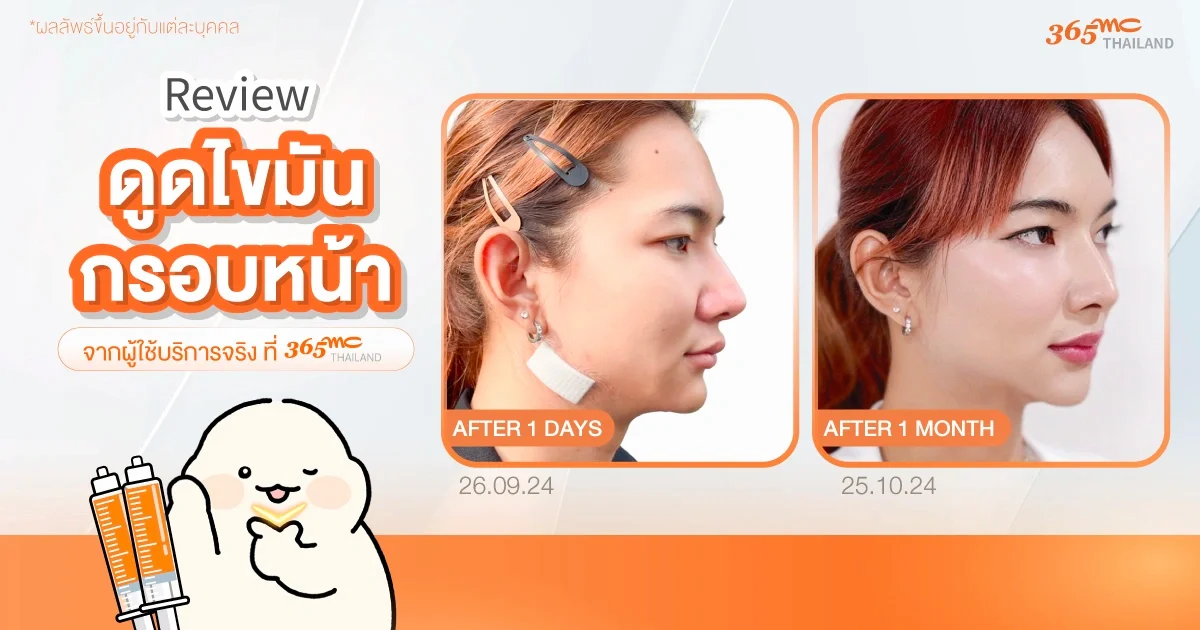 รีวิวดูดไขมันกรอบหน้าก่อน-หลัง