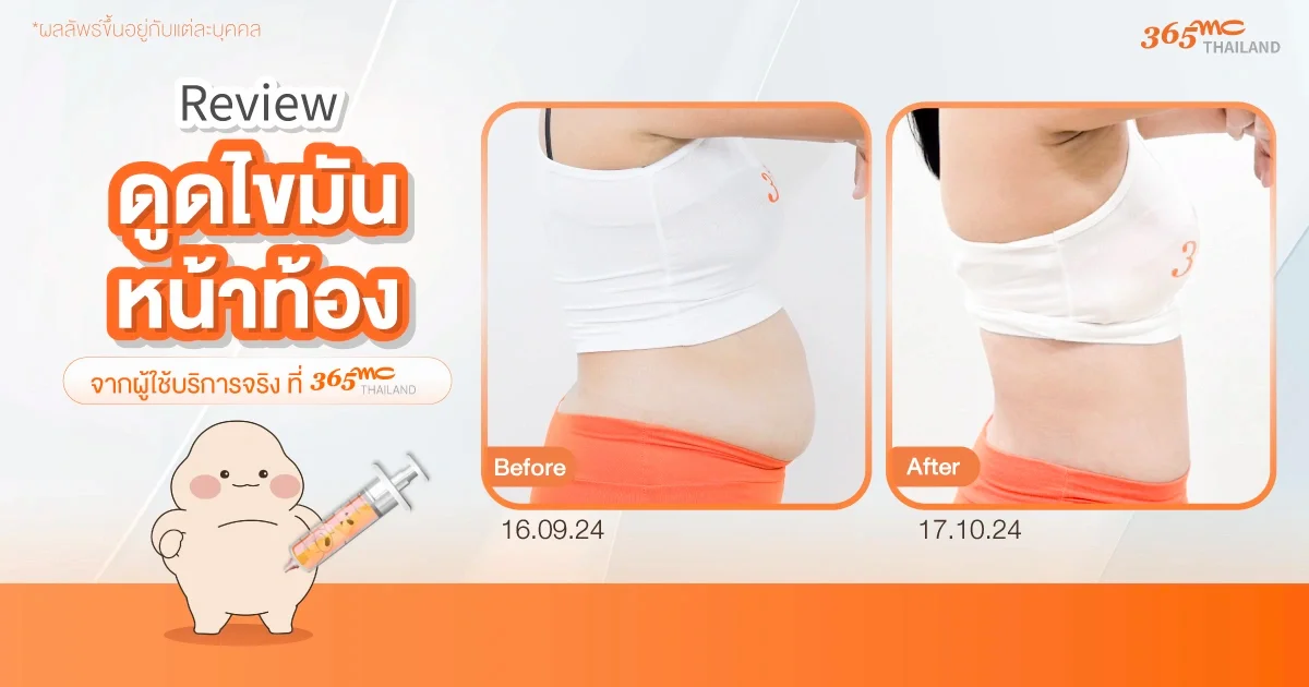 รีวิวดูดไขมันหน้าท้องครบ 1 เดือน