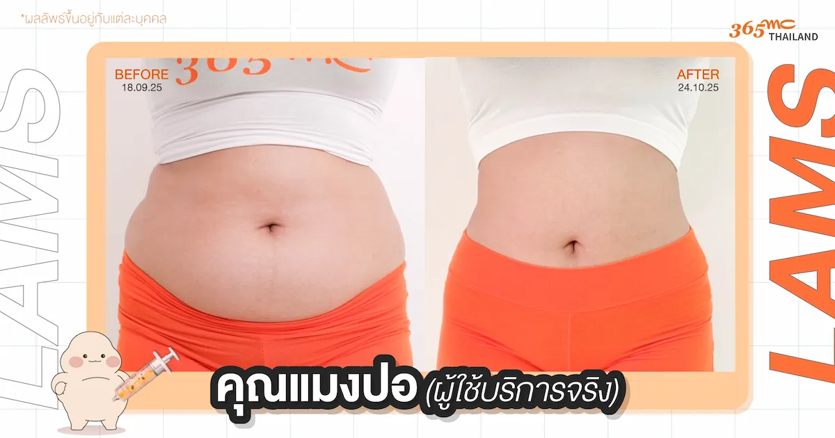 รีวิวดูดไขมัน LAMS คุณแมงปอ