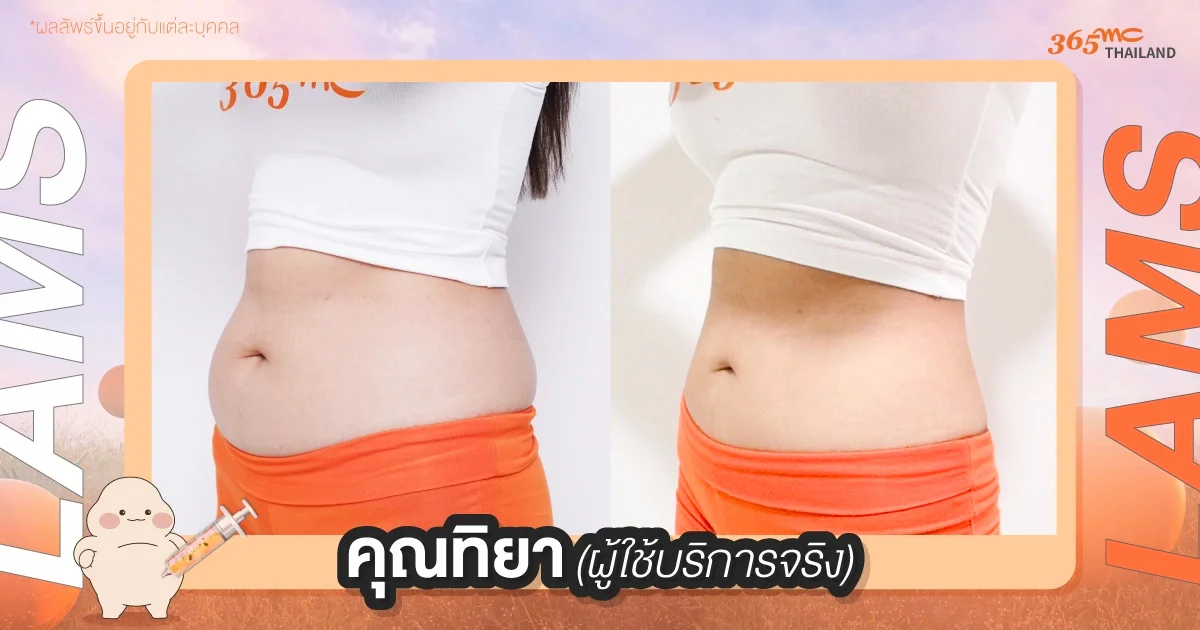 รีวิวดูดไขมัน LAMS ทิยา