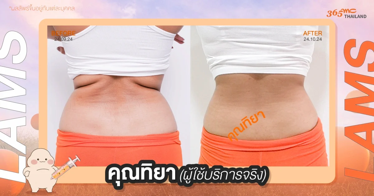 ทิยา รีวิวดูดไขมัน LAMS