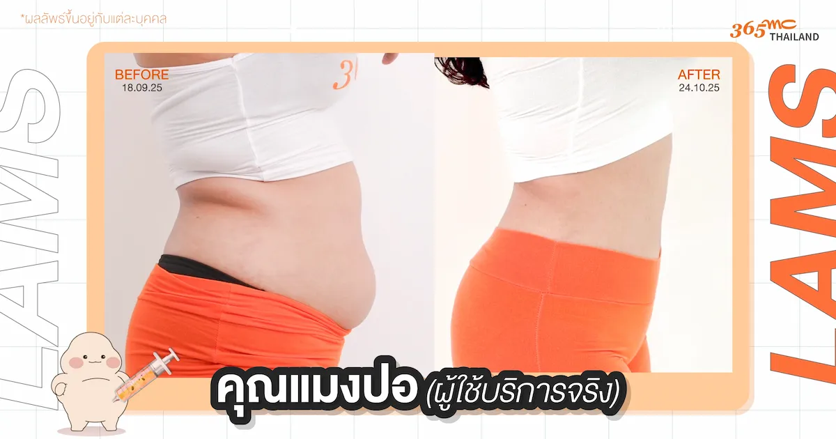 คุณแมงปอ รีวิวดูดไขมัน LAMS