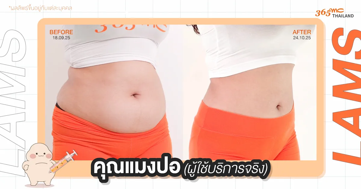 คุณแมงปอดูดไขมัน LAMS รีวิว