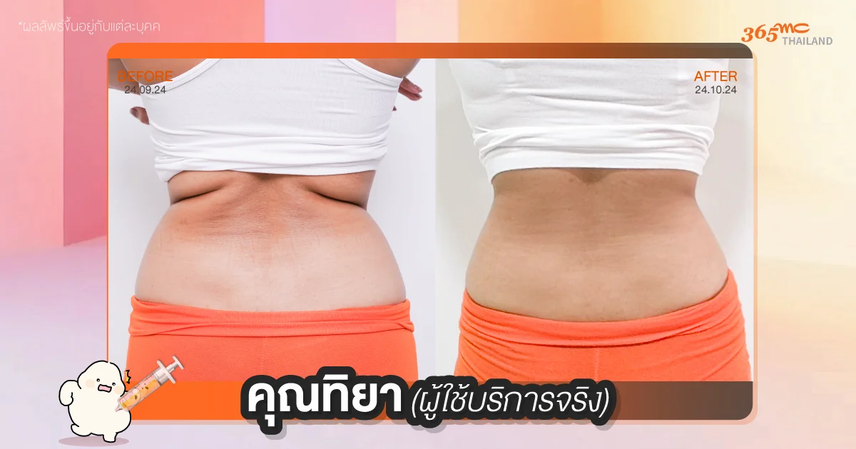 ข้อดี ดูดไขมัน