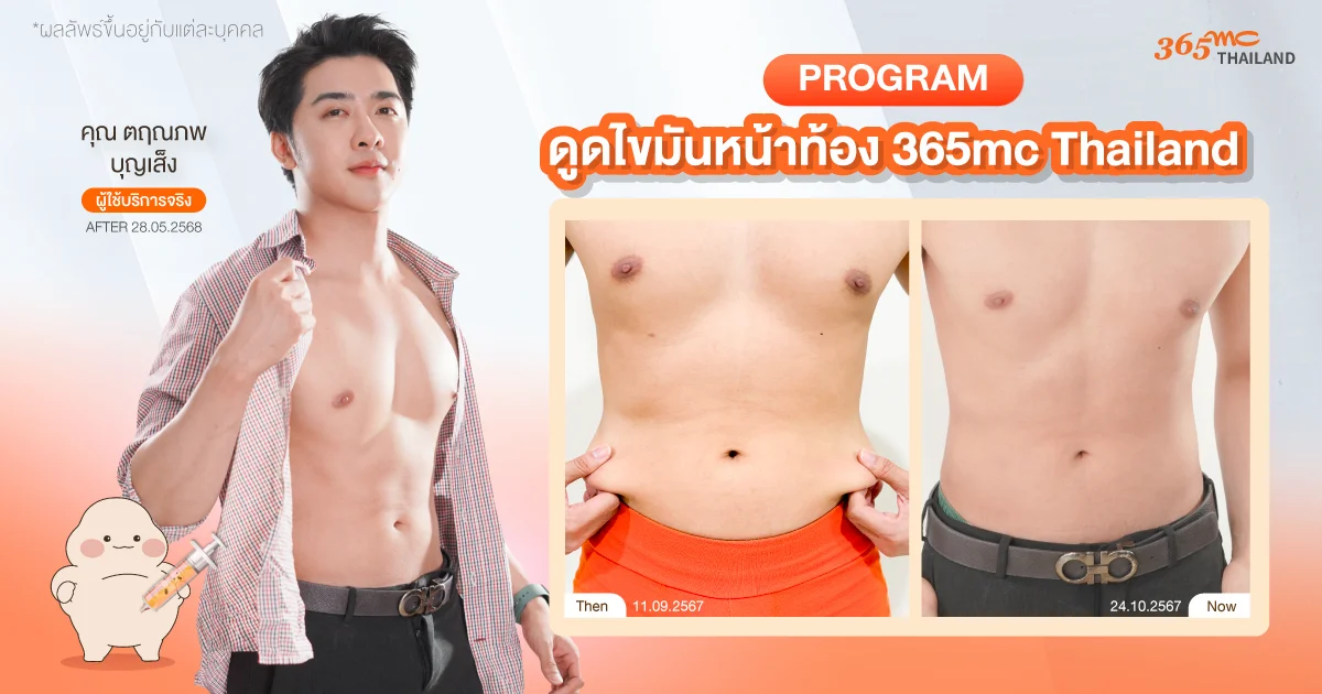 รีวิวดูดไขมันหน้าท้อง